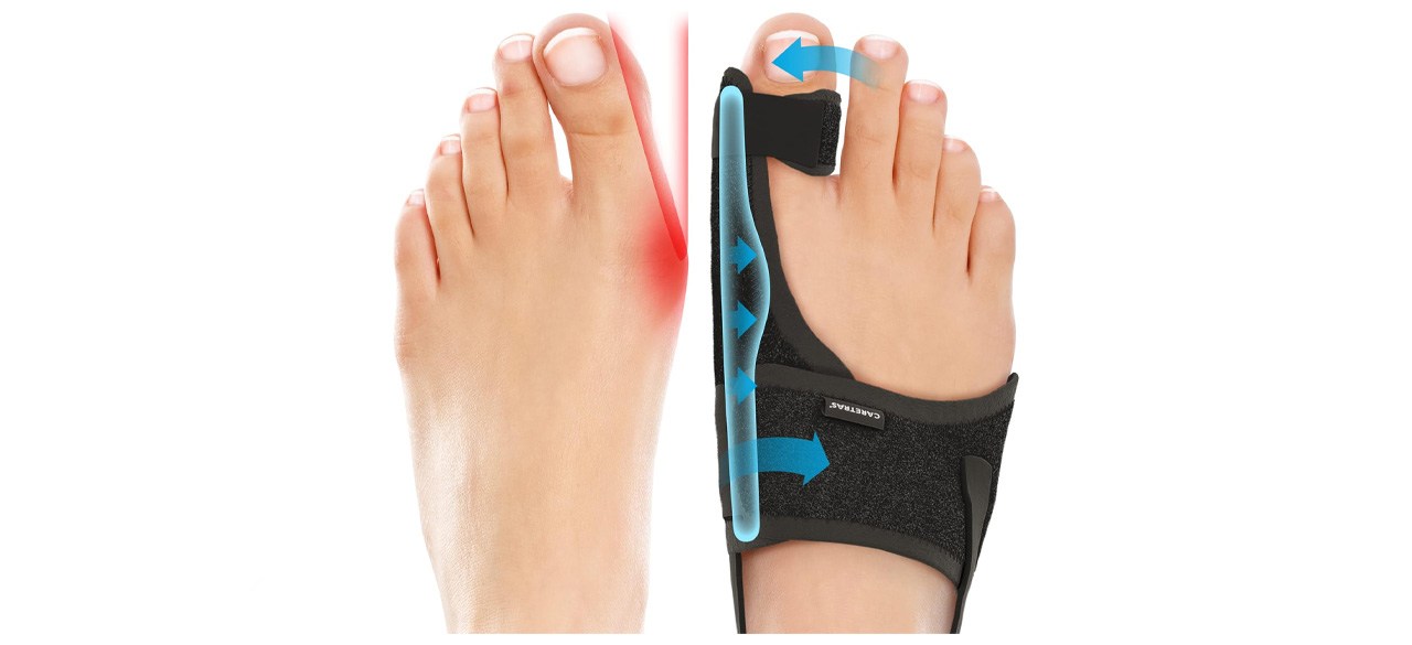 Caretras 2-Pack Bunion Corrector